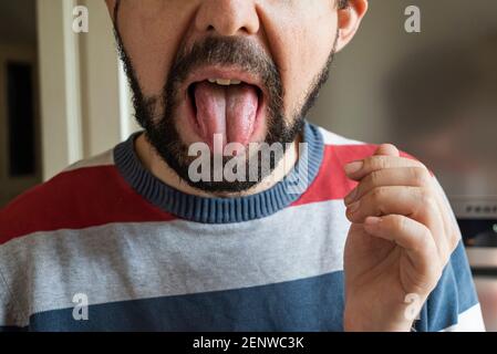 Painful aphtha ulcer of ugly man's mouth with copy space for text. pain from accident. Stock Photo