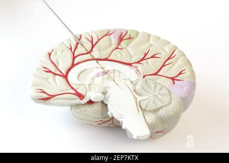 Miicroelectrode recording on the brain model. Concept of brain recording in subthalamic nucleus for Parkinson disease surgery. Stock Photo