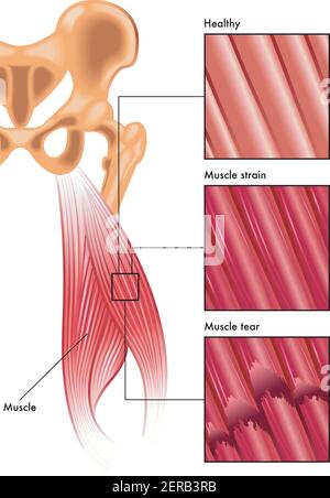 Muscles. Muscle fibers. Anatomy of the human hand. A structure of ...