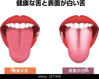 Tongue’s health sign vector illustration ( White coated tongue ) Stock Vector