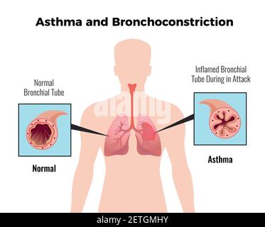 Asthma attack medical educative chart poster with depiction of normal and inflamed bronchial tube flat vector illustration Stock Vector