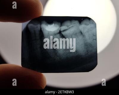 The result of x-ray radiography of the teeth of the oral cavity of the patient to be treated in dentistry Stock Photo