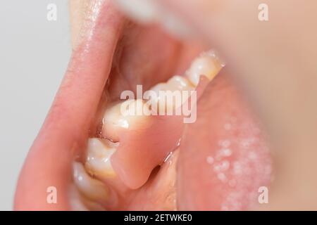 Artificial tooth removable prosthesis in the patient's mouth. Inserted a solitary fake molar in dentistry. Stock Photo