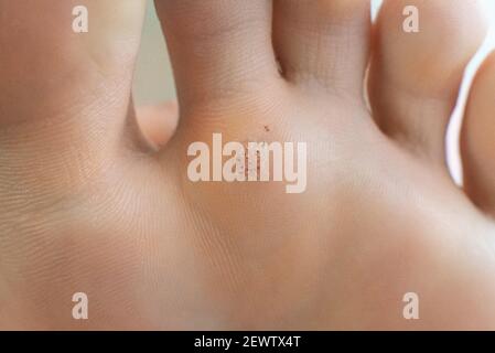 Wart on a blunt close up. Macro shot of human papilloma on the foot Stock Photo