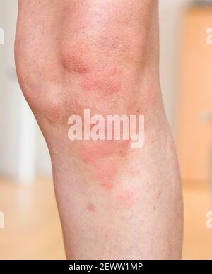 Hives (urticaria), a skin condition. Red skin rash on a woman's body, skin allergy, UK Stock Photo