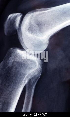Human Leg with Patches and Orthopedic Brace After Anterior Cruciate  Ligament Surgery: in Bed at Hospital Stock Photo - Alamy