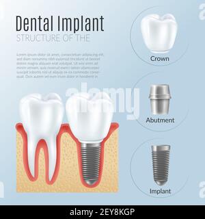 Structure of dental prosthetics infographics poster with denture near healthy tooth crown abutment implant realistic icons vector illustration Stock Vector