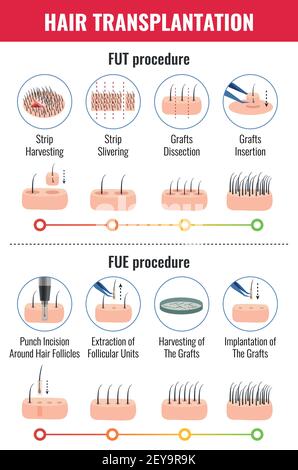 Hair transplant: Effective, safe& reliable way for hair restoration