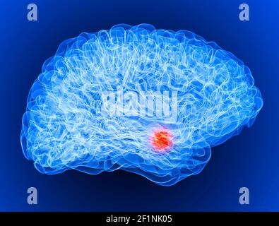 Pain in the head, brain and synapses, cognitive problems, mental deficit. Aneurysm. Degenerative diseases affecting the brain area. Parkinson, stroke Stock Photo