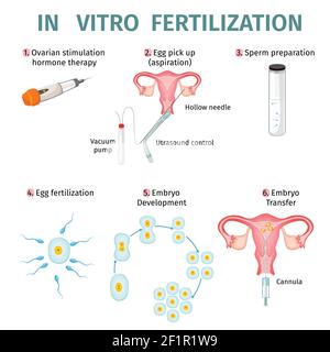 In vitro fertilization concept with steps and procedures of artificial insemination vector illustration Stock Vector
