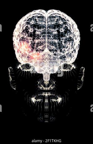 Pain in the head, brain and synapses, cognitive problems, mental deficit. Aneurysm. Degenerative diseases affecting the brain area. Parkinson, stroke Stock Photo