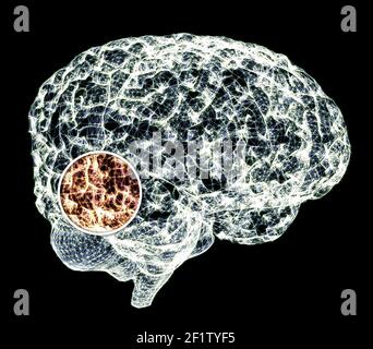 Pain in the head, brain and synapses, cognitive problems, mental deficit. Aneurysm. Degenerative diseases affecting the brain area. Parkinson, stroke Stock Photo