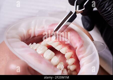 Close up of orthodontist putting braces on woman teeth. Patient with cheek retractor in mouth and orthodontic brackets on teeth at dental clinic. Concept of stomatology and orthodontic treatment. Stock Photo