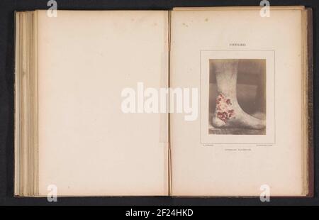 Skin rash caused by syphilis; Syphilide papuleuse plate Stock Photo - Alamy