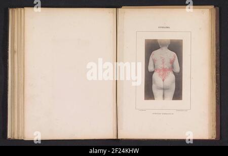 Syphilis In Women Rashes Woman with skin rashes caused by syphilis; Syphilis Vésiculeux Stock ...