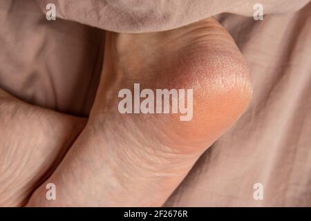 heel in the cracks of the smears on the legs foot barefoot, person dry ointment, sole injury Stock Photo