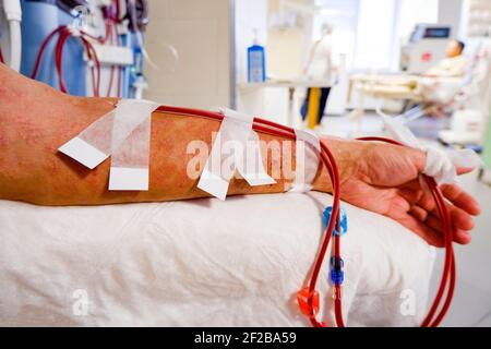 the hand of a patient with a skin lesion is connected to a hemodialysis machine. Stock Photo