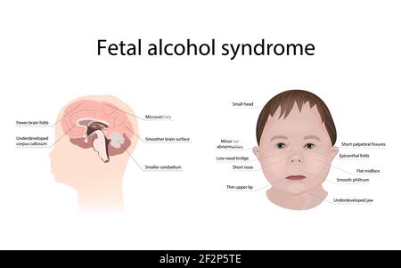 Foetal alcohol syndrome, illustration Stock Photo