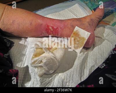 Massive skin inflammation on the lower leg of an elderly Caucasian female is shown after a nonstick pad and cotton wrap bandaging are removed before the dressing is changed at a hospital Wound Center in Florida, USA. Known as 'stasis dermatitis,' this ugly and painful rash was caused by a buildup of fluid due to poor blood circulation in the lower legs that is common to some older adults, especially women. Symptoms of this medical condition include oozing and crusting open sores (ulcers), redness or other discoloration of the skin, swelling and itching. Healing can take considerable time. Stock Photo