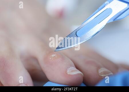 Doctor holding scalpel over corn on womans leg closeup Stock Photo