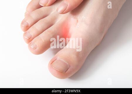 The girl applies a healing ointment between the toes against peeling and irritation of the skin, an unpleasant odor, dermatological Stock Photo