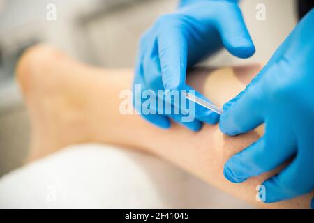 Close-up of a needle and hands of physiotherapist doing a dry needling in a physiotherapy center.. Hands of physiotherapist doing a dry needling Stock Photo