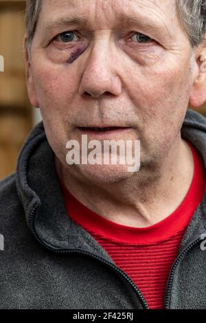 Man with shiner bruise black eye hematoma. Domestic violence male ...