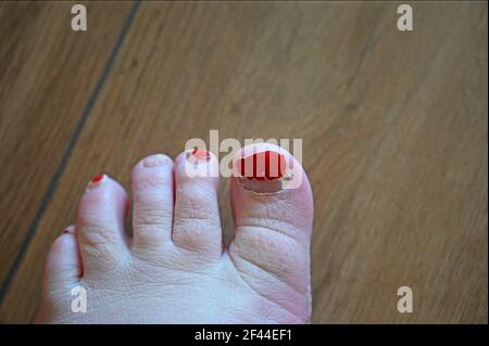 Unkempt toes with selective focus on big toe. Chipped red nail polish, dry skin, overgrown nails, hairy toes. Stock Photo