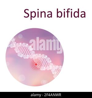 Spina bifida, illustration Stock Photo