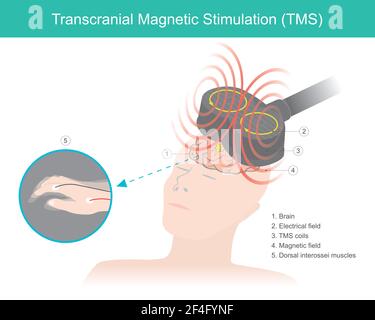 Transcranial Magnetic Stimulation (TMS). The brain stimulation in which a changing magnetic field is used to cause electric current. Healthcare and me Stock Vector