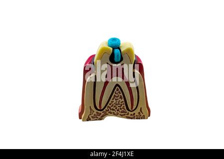 Big tooth dental caries model and candy on wooden isolated on white background.Saved with clipping path. Stock Photo