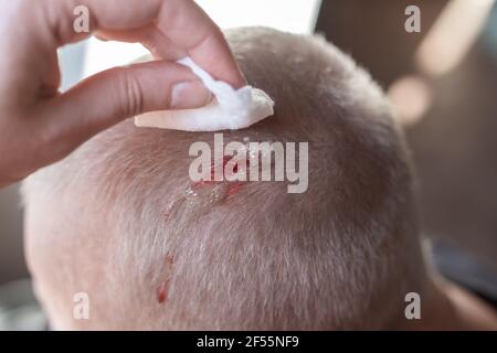 Injury to the scalp. Blood leaks from a chopped wound on the head. A woman is cleaning a wound with a cotton swab with hydrogen peroxide. First aid. Stock Photo