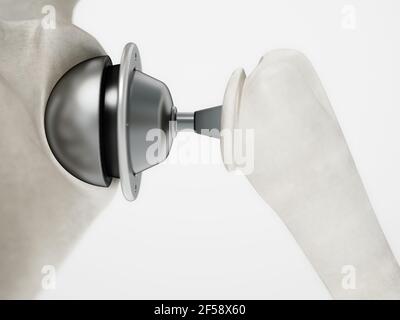 3D illustration of shoulder replacement surgery. 3D illustration. Stock Photo