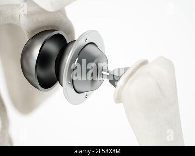 3D illustration of shoulder replacement surgery. 3D illustration. Stock Photo