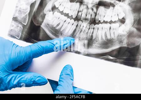 Doctor's hands in protective medical gloves are holding and examining the x-ray of the teeth, closeup. Stock Photo