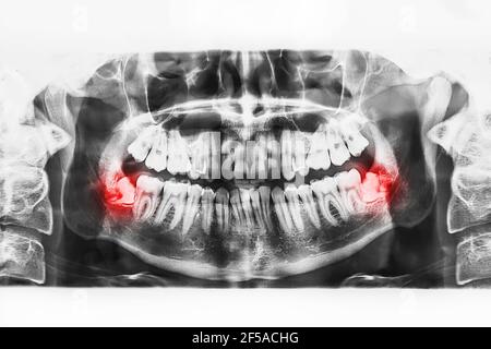 X-ray image of oral cavity with growing lower wisdom teeth on white background. Stock Photo