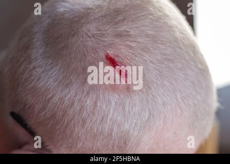 Injury to the scalp. Blood leaks from a chopped wound on the head of a blond man due to falling metal reinforcement. Non-observance of safety precauti Stock Photo