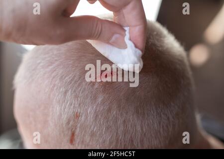 Injury to the scalp. Blood leaks from a chopped wound on the head. A woman is cleaning a wound with a cotton swab with hydrogen peroxide. First aid. Stock Photo