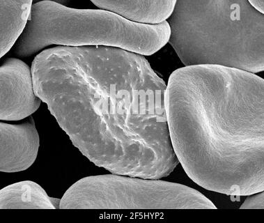 Red blood cells infected with malaria. Stock Photo