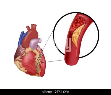 Thrombosis in Coronary Artery Stock Photo