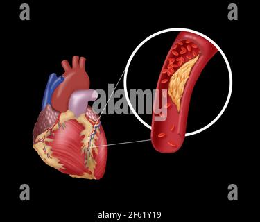 Atherosclerotic Coronary Artery Disease Stock Photo