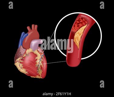 Thrombosis in Coronary Artery Stock Photo