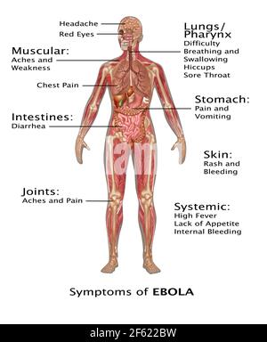 Ebola Virus Symptoms in Human, Illustration Stock Photo