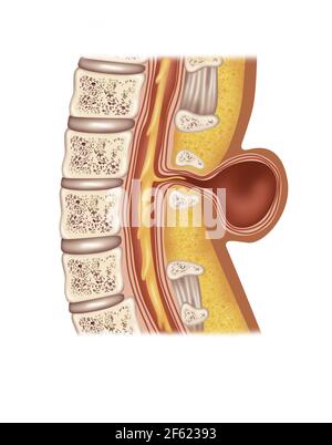 Spina Meningocele, Illustration Stock Photo