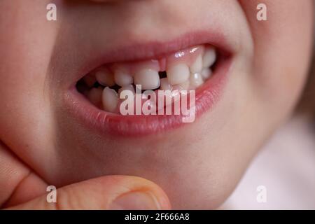 Close-up macro of a child's slightly open mouth with teeth removed in the lower row of teeth Stock Photo