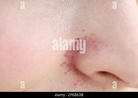 Rash on skin near woman nose closeup Stock Photo