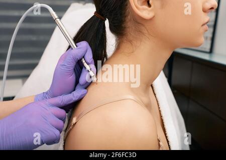 Woman having mole removal in medical center using non-contact laser. Painless removal of moles and papillomas on human skin Stock Photo