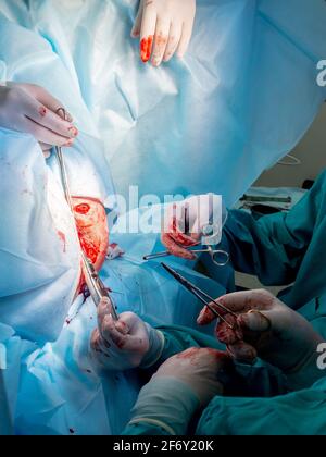 The bloody hands of surgeons in sterile gloves work with a medical instrument during a surgical operation. Stock Photo