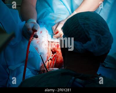 The bloody hands of surgeons in sterile gloves work with a medical instrument during a surgical operation. Stock Photo