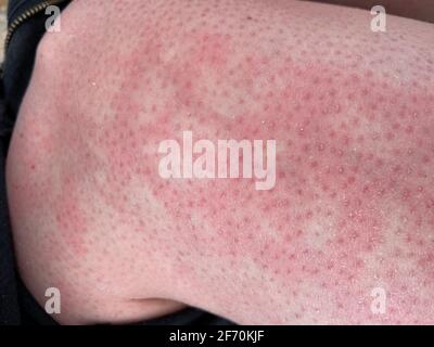 mottled skin heat rash hives allergy reaction on knee close-up reference picture of blotchy mottled red skin erythema ab igne also known as EAI Stock Photo